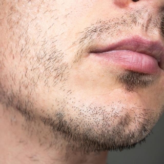 Beard Alopecia: Causes And Treatments