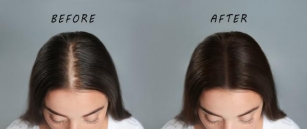 Unveiling The Power Of Scalp Micro Pigmentation: The Ultimate Hair Loss Solution