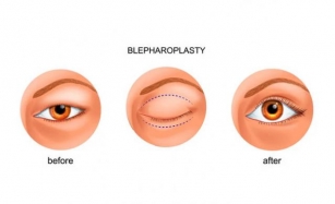 Blepharoplasty: Eyelid Surgery Cost And Procedure