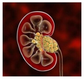 Global Urgency Declared By Groups For WHO Recognition Of Chronic Kidney Disease Threat