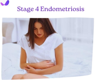 Stage 4 Endometriosis: Does It Affect Life Expectancy?