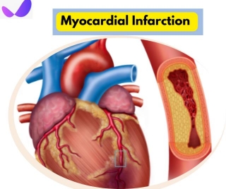 Myocardial Infarction Treatment & Save Your Heart