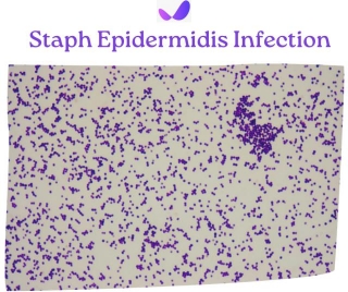 Staph Epidermidis Infection: Diagnosis, Treatment, And Prevention