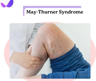 May-Thurner Syndrome: A Hidden Cause Of Leg Pain