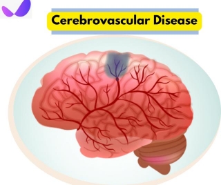 Cerebrovascular Disease: Tips For Management & Improvement (2024)