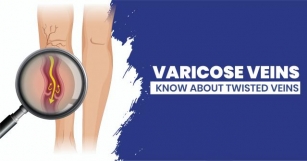 Varicose Veins – Diagnosis, Treatment And Causes