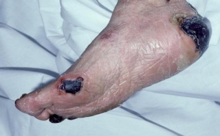 Gangrene Symptoms, Causes, Treatment, And More