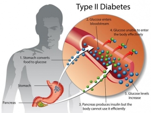 What Is Type 2 Diabetes Silent Signs & Taking Control.