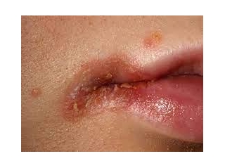 A Deeper Look Into Angular Cheilitis: Causes, Symptoms, Treatments, And Patient Pathway