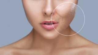 A Combination Of Non-ablative Laser And Hyaluronic Acid Injectable (PROFHILO) For Postacne Scars