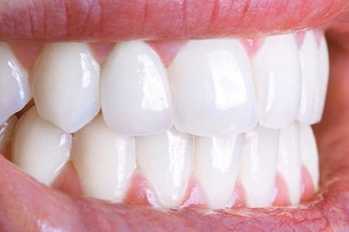 Discover The Brilliance Of Gloss Veneers: Transform Your Smile Effortlessly