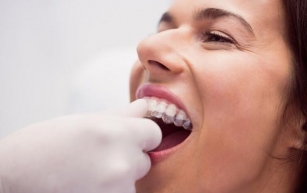 Diferentes tipos de ortodoncia para cada necesidad