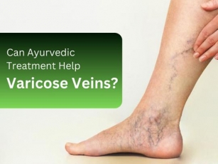 Ayurvedic Treatment For Varicose Veins: Does It Work?