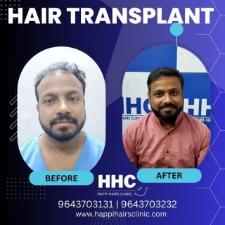 Title: Debunking Myths Surrounding Hair Transplant: Exploring Happi Hairs Clinic In Delhi