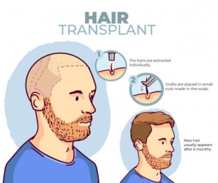 Complete Guide For Hair Transplant By Cutibless: Best Hair Transplant In Bangalore