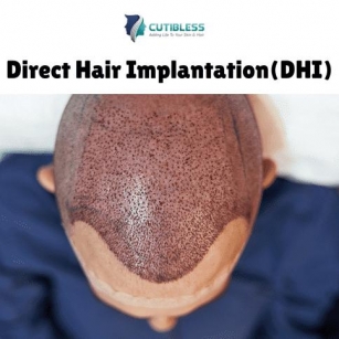 Why Direct Hair Transplant(DHI) Is The Ultimate Solution For Hair Loss? Cutibless, Bangalore