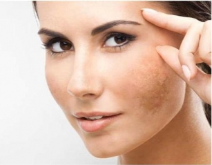 Understanding Facial Pigmentation And Effective Treatments With Cutibless Best Skin Care In Bangalore