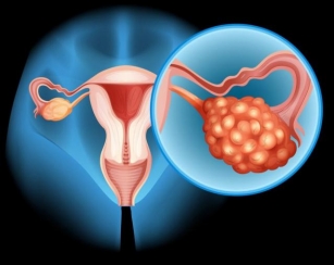 What Is PCOD Or PCOS – Symptoms, Treatment