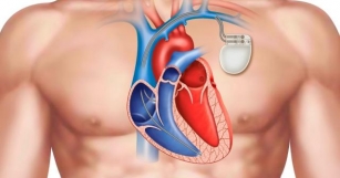 The Cardiac Pacemaker Market: A Steady Beat In Medical Technology