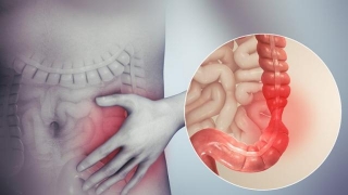 IBS 5 Risk-reduction Strategies To Manage Irritable Bowel Syndrome