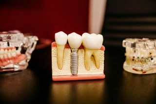 Manfaat Implan Gigi Dan Kelebihan Melakukannya Di Arirang Dental Clinic