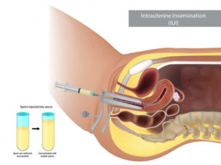 Understanding Intrauterine Insemination (IUI) For Treating Infertility