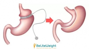 Bariatric Revision Surgery: Getting A Second Chance At Weight Loss