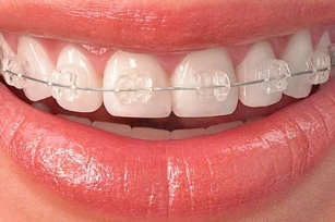 Smile Brighter With Orthodontic In Fort Lauderdale FL