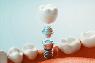 Navigating The Path Of The Dental Implant Procedure: A Journey To Renewed Smiles