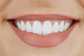 Unlocking The Secret To Affordable Veneers: A Guide To Budget-Friendly Smile Transformations