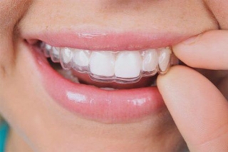 The Straight Path To A Winning Smile: Exploring Teeth Straightening