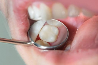 Expert Dental Fillings At JJ Dental