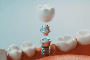 Full Mouth Dental Implants In Fort Lauderdale FL