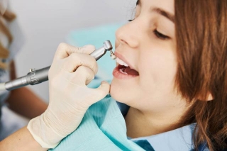What Is Tooth Polishing?