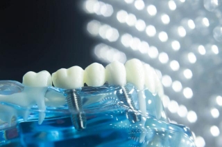 Recognizing Signs Of Dental Implant Failure