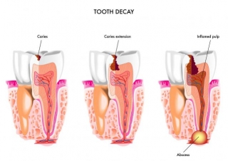 Understanding The 5 Stages Of Tooth Decay 