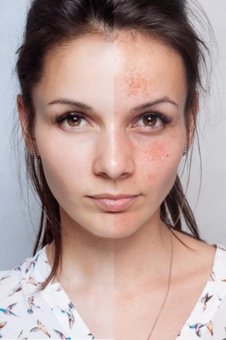 Dermal Fillers And Their Transformative Role In Minimizing Acne Scars