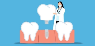 Dental Implants Vs. Dentures: Everything You Need To Know