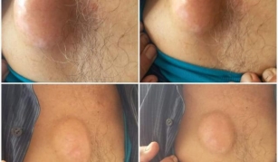 Sebaceous Cyst On Chest