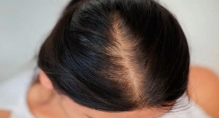 Alopecia Androgénica En Mujeres: Soluciones Efectivas Para Recuperar Tu Cabello