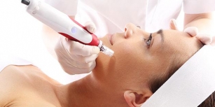 Unveiling The Secrets Of Radiofrequency Microneedling: Transform Your Skin