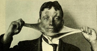 Cutis Laxa, An Extremely Rare Connective Tissue Disorder, 1907